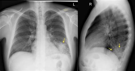 An x-ray releases a low dose of electromagnetic radiation through the chest to capture photos of the bones and tissues, including: Heart. . Pneumonia rib pain